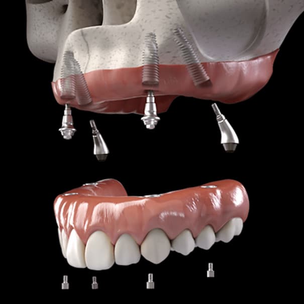 Full arch implant-supported dental restoration